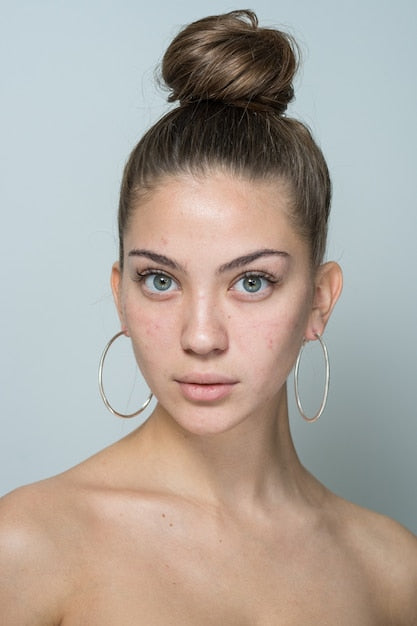 files/retrato-do-close-up-de-uma-jovem-mulher-bonita-com-pele-problematica-acne-acne-vermelhidao-da-pele_239004-246.jpg